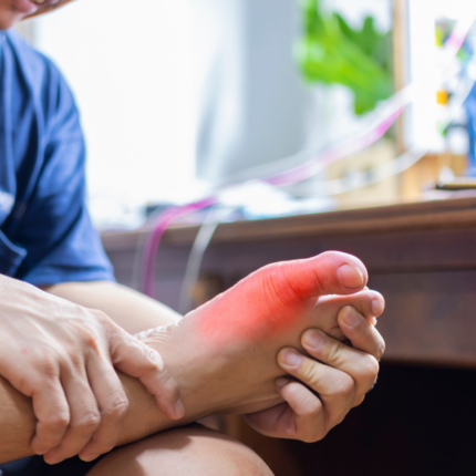 Hyperuricemia with Gout w/o Tophus
