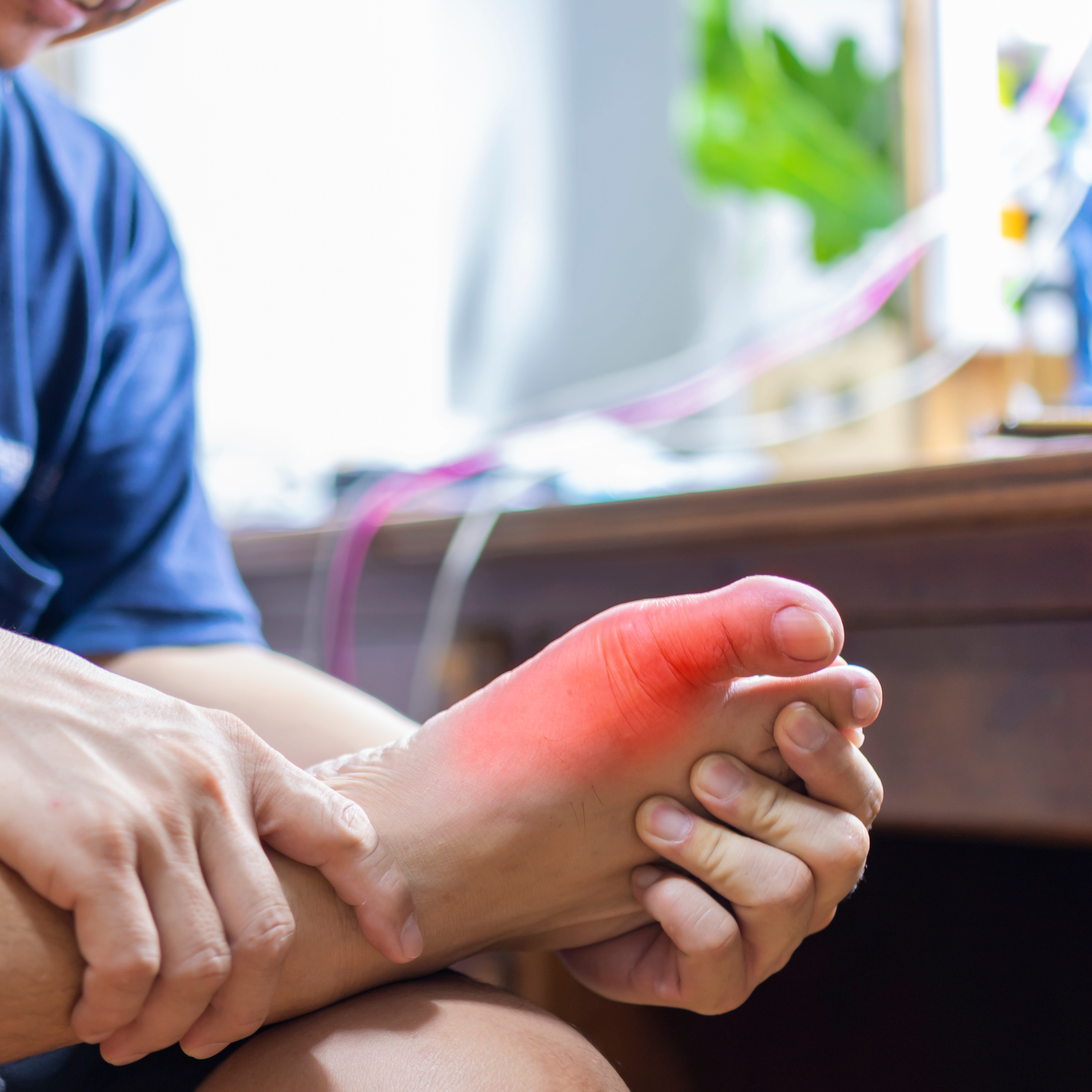 Hyperuricemia with Gout w/o Tophus